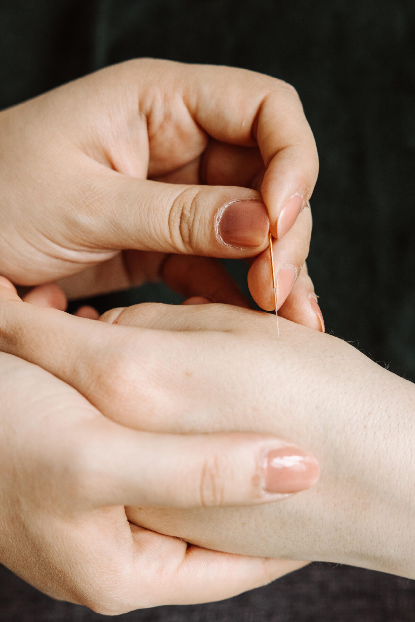Frauenhände mit Akupunkturnadel